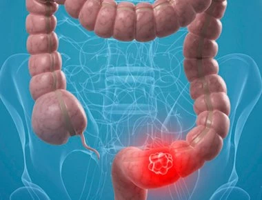 Πότε να κάνεις εξετάσεις για να αποφύγεις τον καρκίνο παχέος εντέρου;